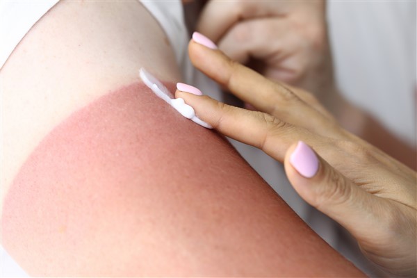 How to treat sunburn fast